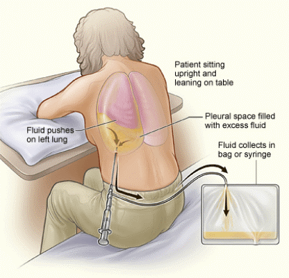 Thoracentesis: What You Need to Know! 