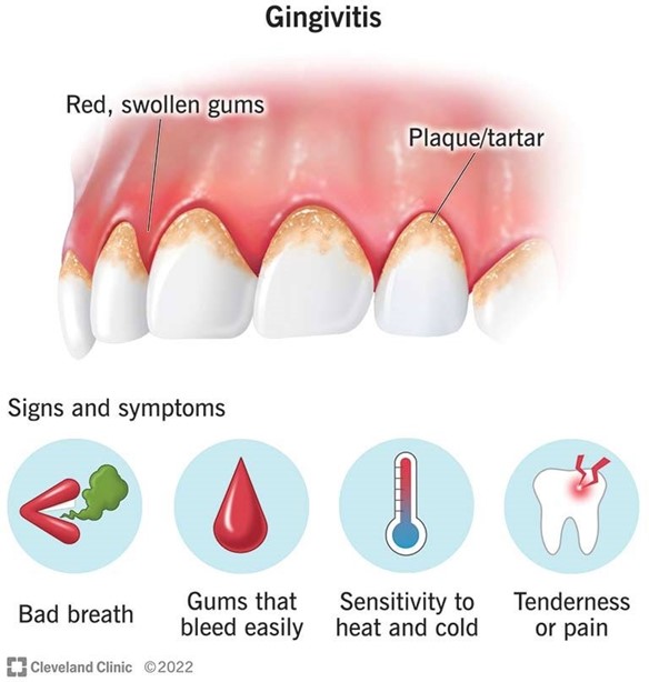 Gingivitis: Symptoms and How To Treat It 