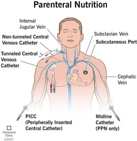 Parenteral Nutrition: What it Is, Uses & Types 