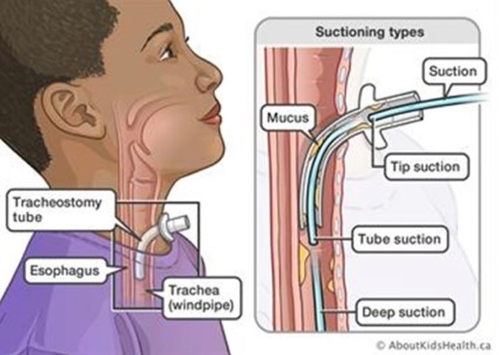 Suctioning Types