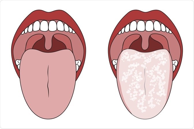 Oral Thrush (Candidiasis) Treatment