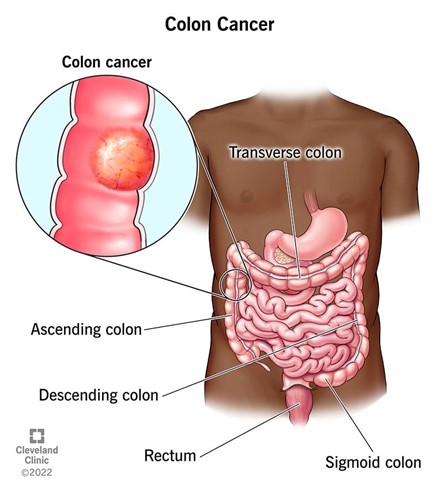 Colon Cancer: Symptoms, Stages & Treatment