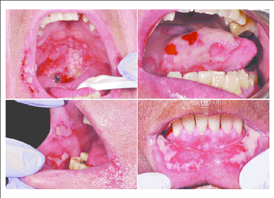 Oral Mucositis | Exodontia