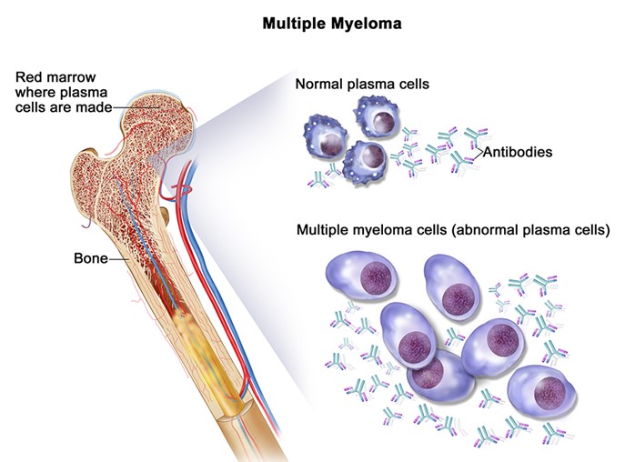 Myeloma | CDC