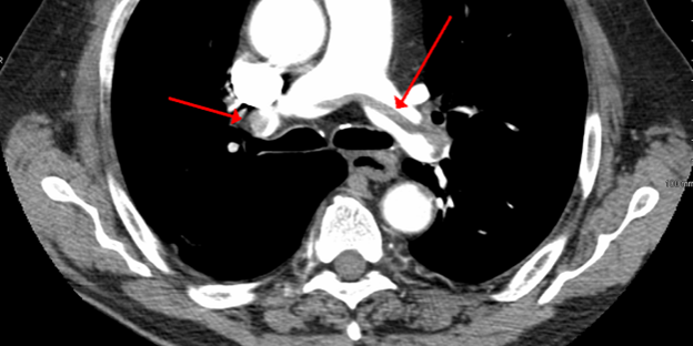 CT pulmonary angiography is the gold standard for diagnosing PE.