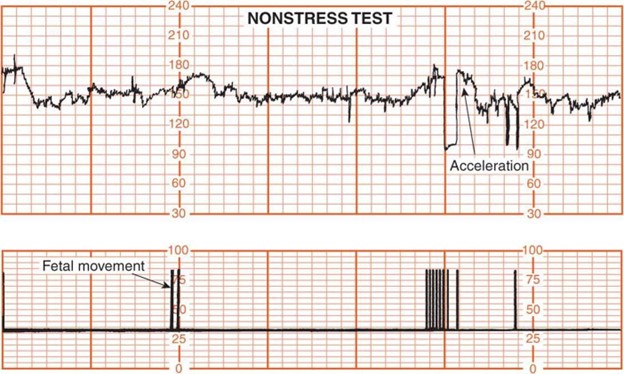 Fetal Non Stress Test NST Chapters Naxlex Nursing