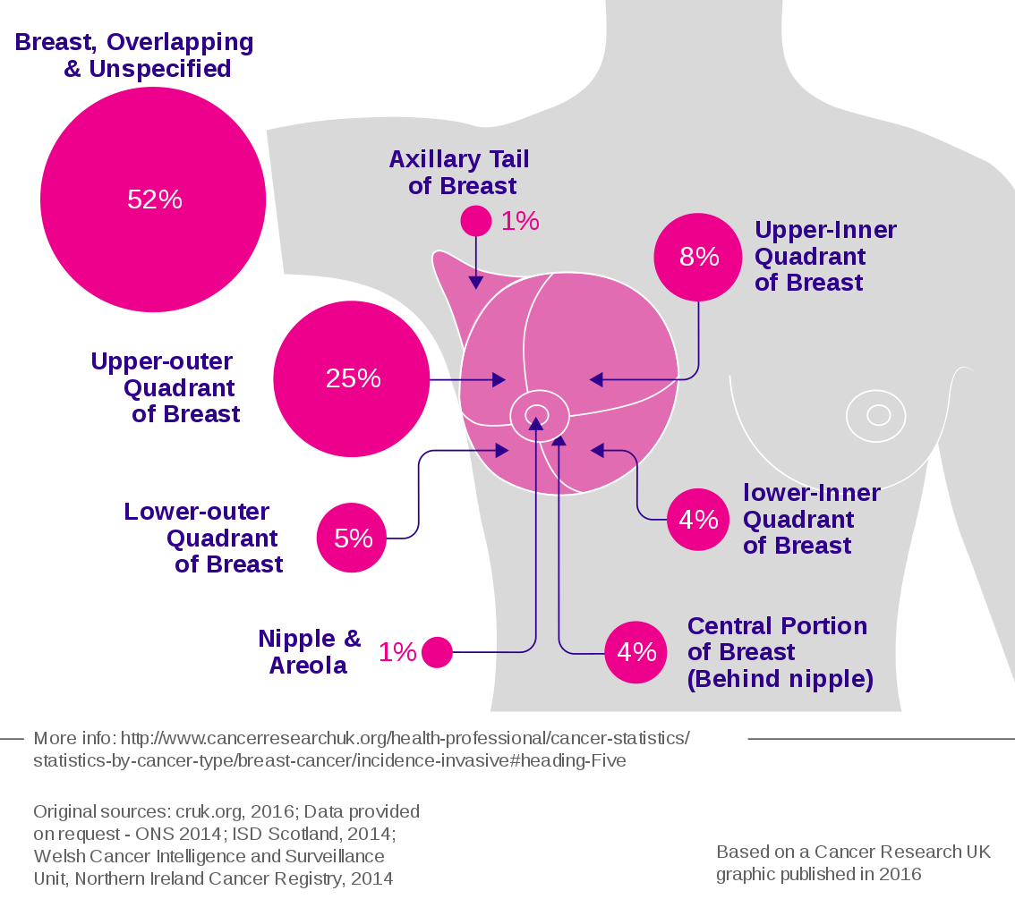 Breast quadrants definition: Upper-Outer (UOQ), Upper-Inner (UIQ)
