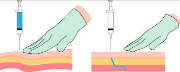 The nurse must give a client an intramuscular injection o | Nursing Exam