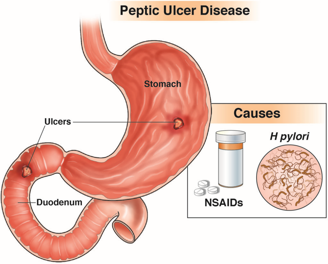 A client with peptic ulcer disease receives a new prescri