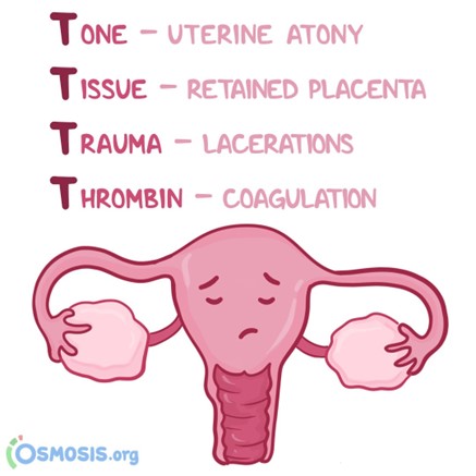 Osmosis from Elsevier on Twitter: "Use this 4T mnemonic to help you  remember the causes of postpartum hemorrhage: TONE - Uterine atony TISSUE - Retained  placenta TRAUMA- Vaginal/Cervical/Perineal lacerations THROMBIN -  Disseminated