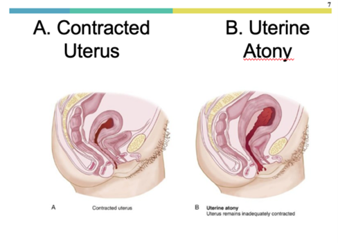 Uterine Atony: What Is It, Risk Factors, Treatment, And More Osmosis |  gltcomercial.com.ar