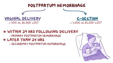 Postpartum hemorrhage: Clinical (To be retired): | Osmosis