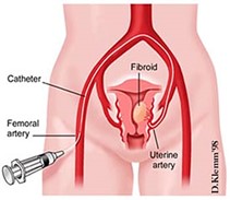 Uterine artery embolization,uterine fibroid  embolization,Toronto,Ontario,Canada