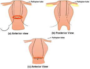B-lynch suture technique. | Download Scientific Diagram