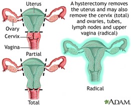 Hysterectomy: MedlinePlus Medical Encyclopedia