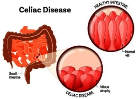 Dietary Changes for Celiac Disease